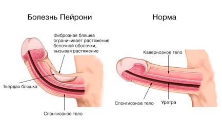 пейрони болезнь у мужчин