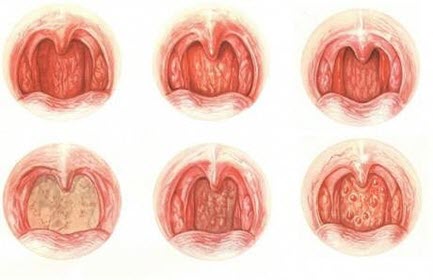 типы фарингита